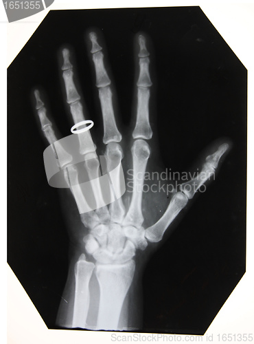 Image of black and white photo of x-ray picture of woman hand with the ring