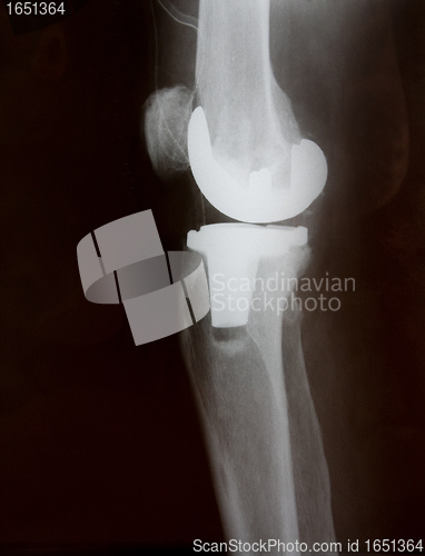 Image of Total knee replacement x-ray side picture