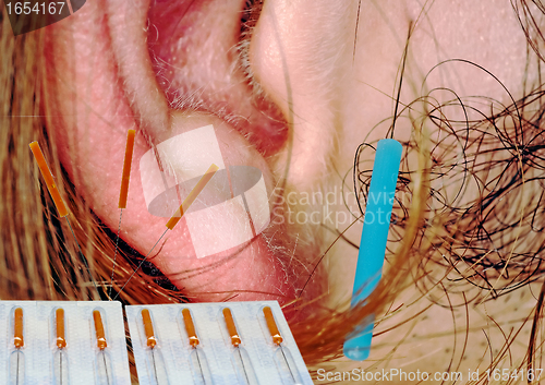 Image of ear acupuncture