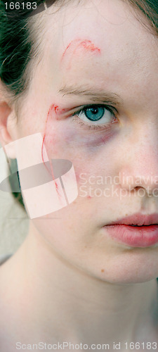 Image of Injured cheek