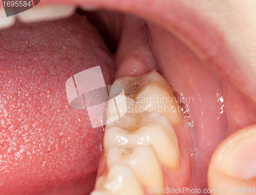 Image of Macro image of filled teeth