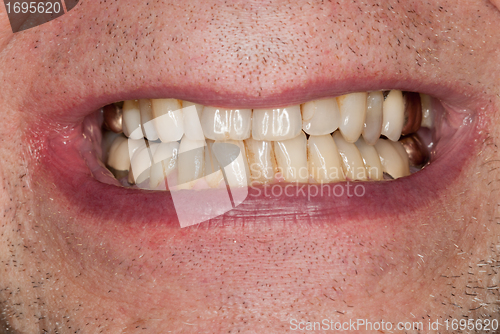 Image of Macro image of filled teeth