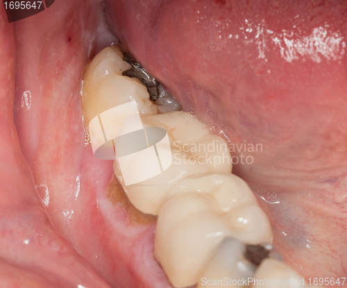 Image of Macro image of filled teeth