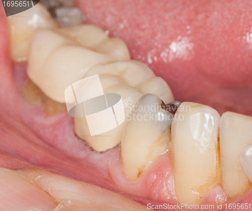 Image of Macro image of filled teeth