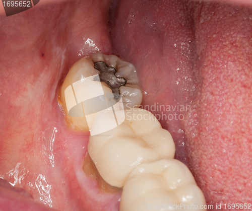 Image of Macro image of filled teeth