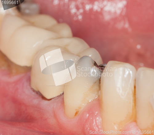 Image of Macro image of filled teeth