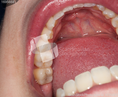 Image of Macro image of filled teeth