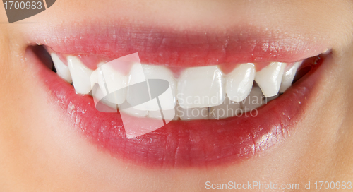 Image of White healthy teeth