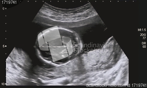 Image of Ultrasonography Analysis of a 4th Month Fetus