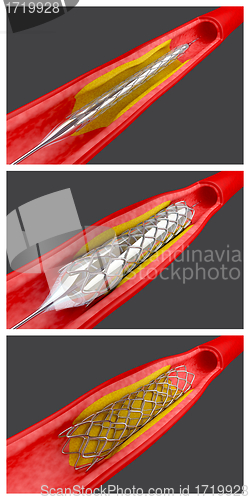 Image of Angioplasty