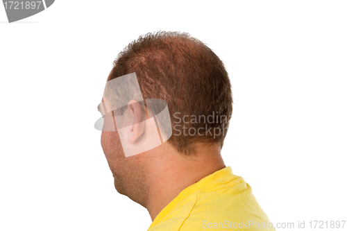 Image of Young man with hair problem