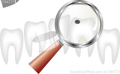 Image of decayed tooth under  magnifying glass ,  dentistry