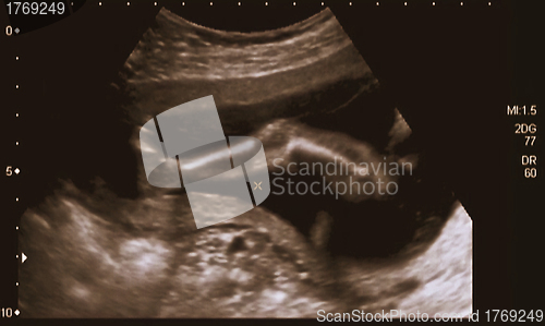 Image of Ultrasonography Analysis of a 4th Month Fetus