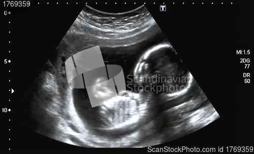 Image of Ultrasonography Analysis of a 4th Month Fetus