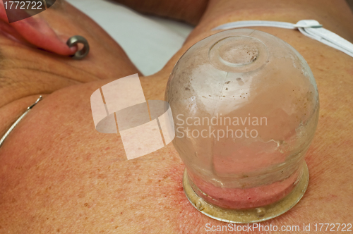 Image of cupping