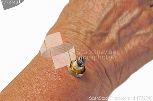 Image of Moxibustion, chinese warming therapy
