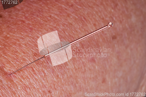 Image of acupuncture 