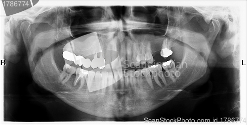 Image of Teeth on X-Ray Image