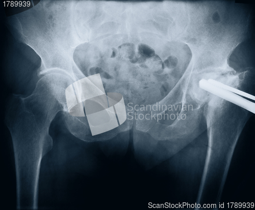 Image of x-ray with bolt