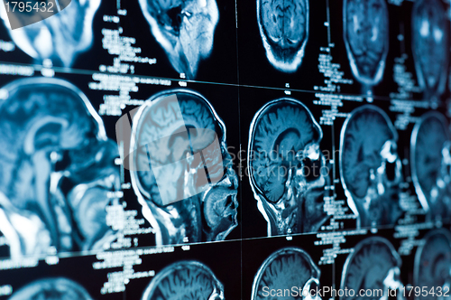 Image of Closeup of a CT scan with brain and skull on it