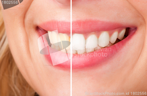 Image of Dental Whitening