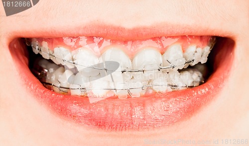 Image of Braces