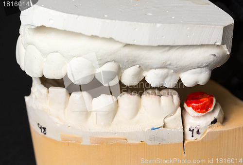 Image of Mold of teeth taken for orthodontics