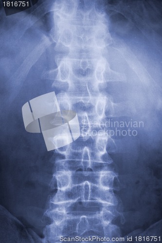 Image of Spine on x-ray