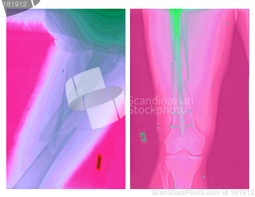 Image of Real X-rays of Femur Fracture-Before and After