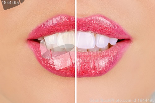 Image of whitening