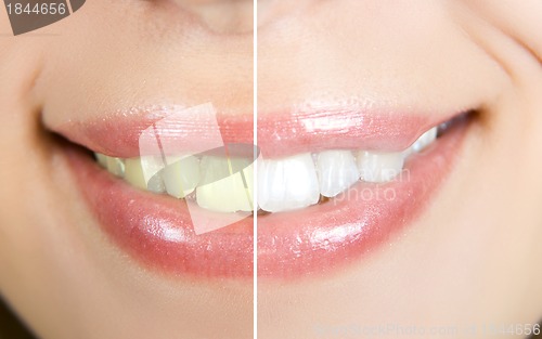 Image of whitening