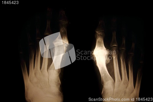 Image of x-ray of foots 