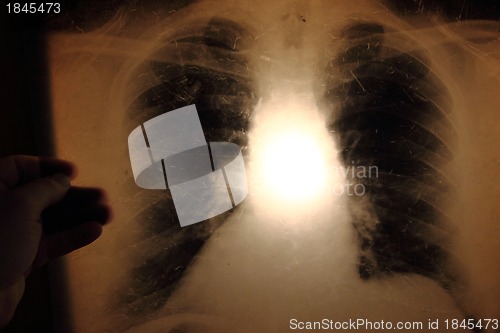 Image of x-ray of lungs