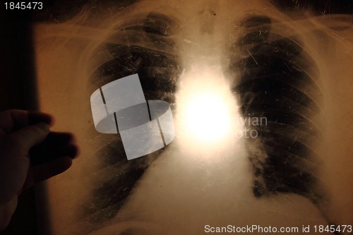 Image of x-ray of lungs