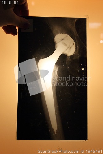 Image of x-ray of hip endoprosthese