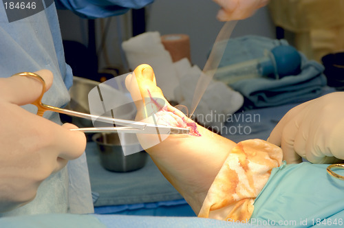 Image of Foot Surgery - Bunionectomy - Suturing