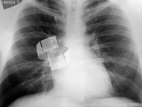 Image of Xray Chest Positive