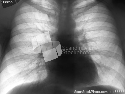 Image of Xray Chest Negative