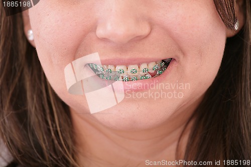 Image of Close-up of a smiling young teenager with braces 