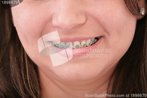 Image of teeth with braces 