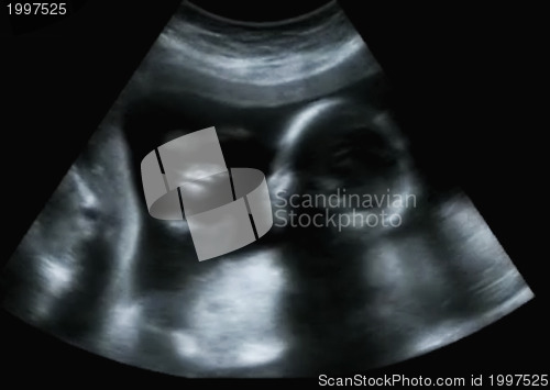 Image of Obstetric Ultrasonography Ultrasound Echography of a first month