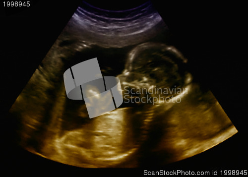 Image of Obstetric Ultrasonography Ultrasound Echography of a first month