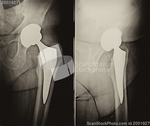 Image of Radiography of operation of implantation of a prostheses in the 