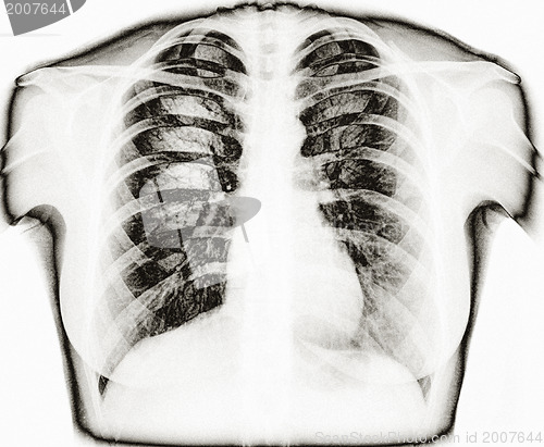 Image of X-Ray Image Of Human Healthy Chest