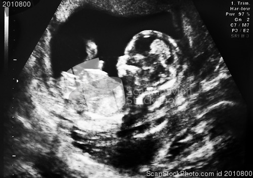 Image of ultrasound of fetus