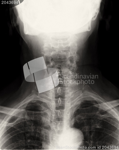 Image of Spinal Column Back Upper Part xray