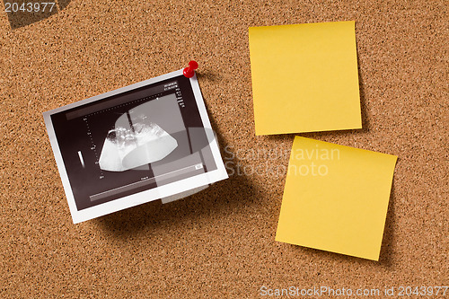 Image of ultrasound photo on corkboard