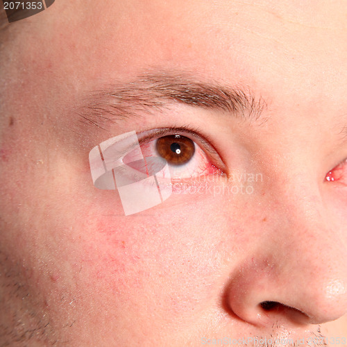 Image of Man with conjunctivitis
