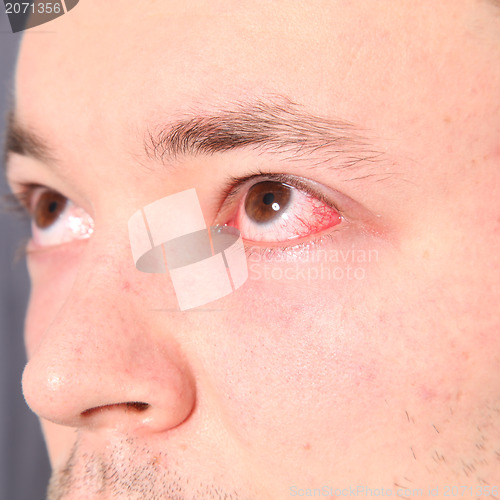 Image of Man suffering from conjunctivitis