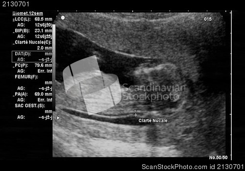 Image of ultrasound fetus